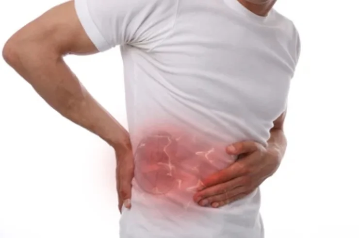 Kidney Stones