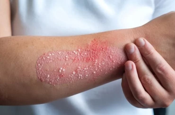 Skin Diseases
